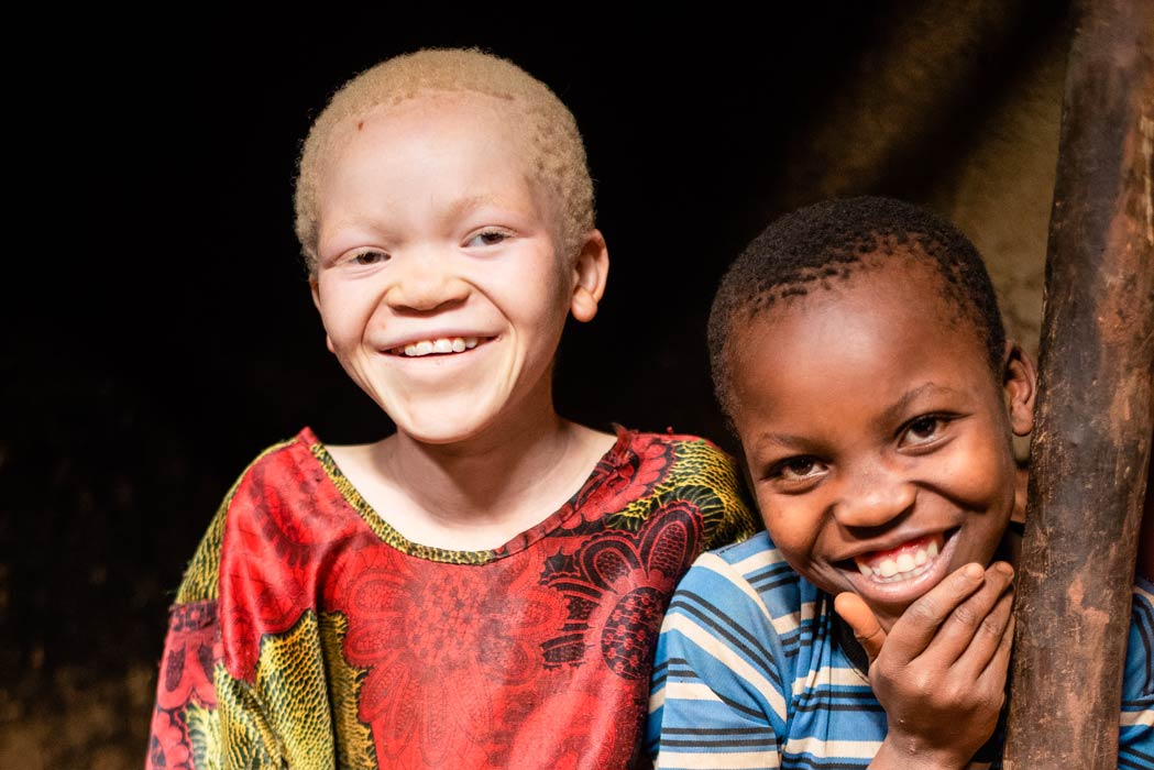 Unfolding the Journey of Albinism